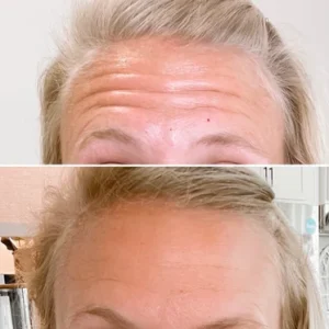 Before and After photos in beach Medical Aesthetics