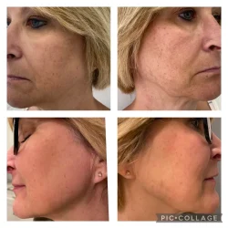 Before and After Gallery in beach Medical Aesthetics