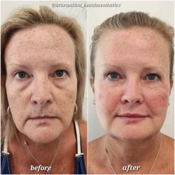 Before and After Gallery in beach Medical Aesthetics