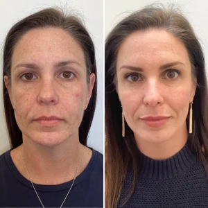 full face rejuvenation-1