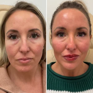 full face rejuvenation