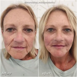 Before and After Gallery in beach Medical Aesthetics