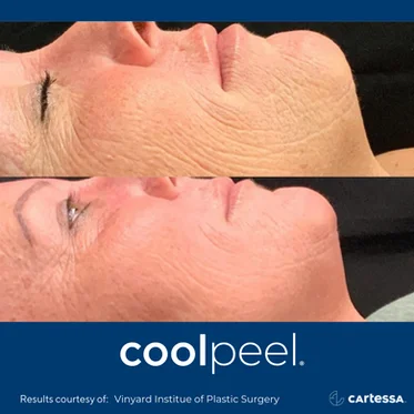 Cool peel | Before and After photos in Wilmington NC