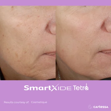 Before and After Gallery in beach Medical Aesthetics