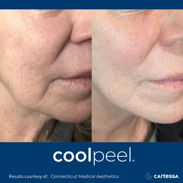 Cool peel | Before and After photos in Wilmington NC