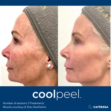 Cool peel | Before and After photos in Wilmington NC