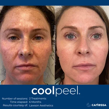Cool peel | Before and After photos in Wilmington NC