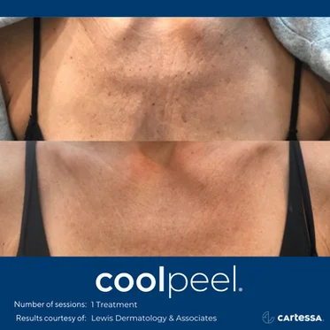 Cool peel | Before and After photos in Wilmington NC